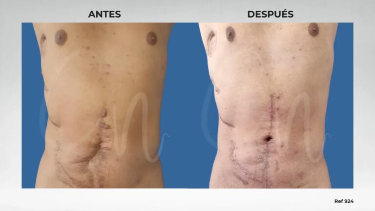 Costo de la Cirug&iacute;a para Corregir Cicatrices