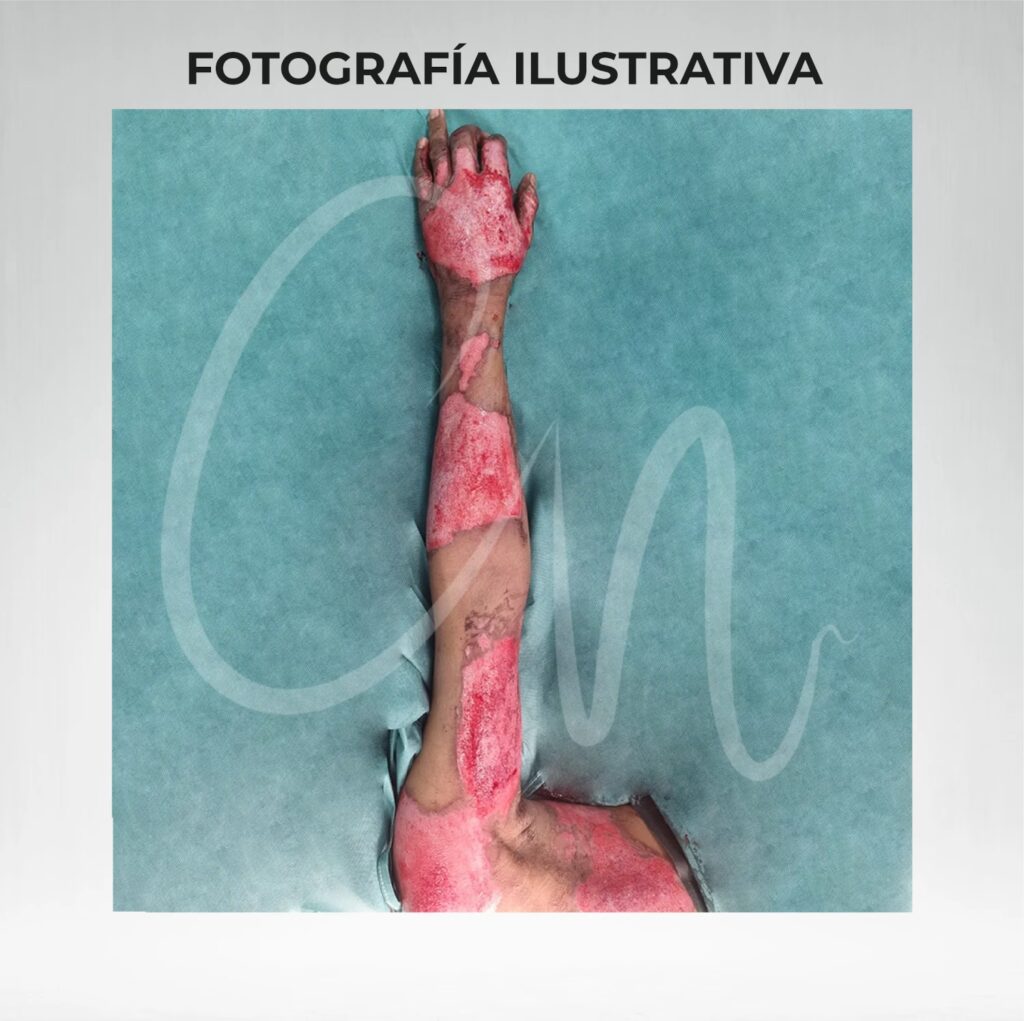 Ardor Postquirúrgico: ¿Es Normal y Cuánto Dura?