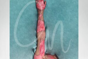 Ardor Postquirúrgico: ¿Es Normal y Cuánto Dura?