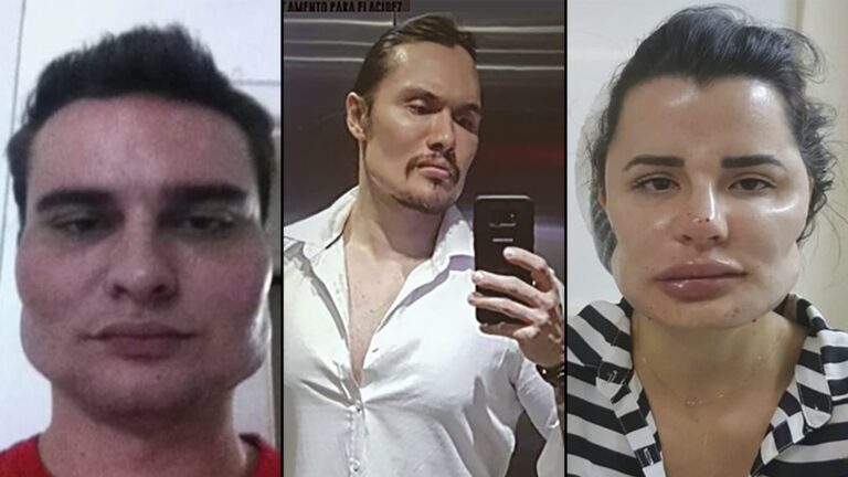 Cirug&iacute;a Pl&aacute;stica Fallida: Causas y Soluciones