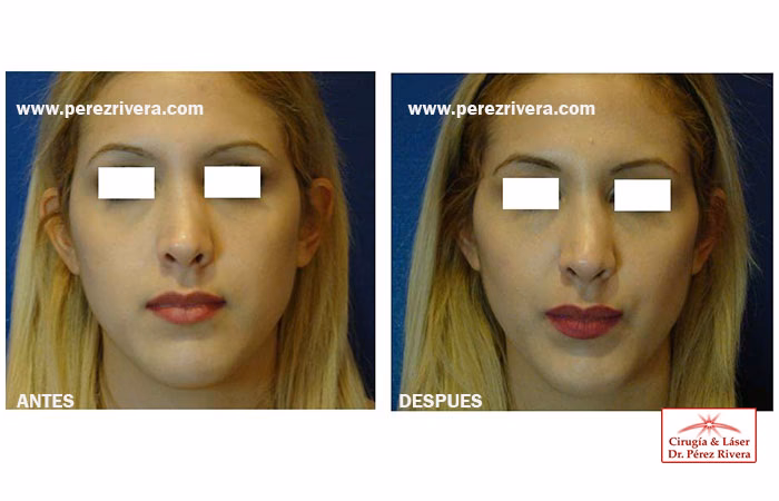 Bichectom&iacute;a: El Secreto de un Rostro Definido