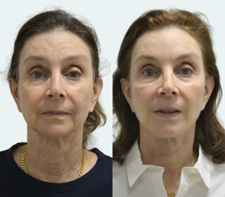 Costo de la Cirug&iacute;a de Papada en Puerto Rico