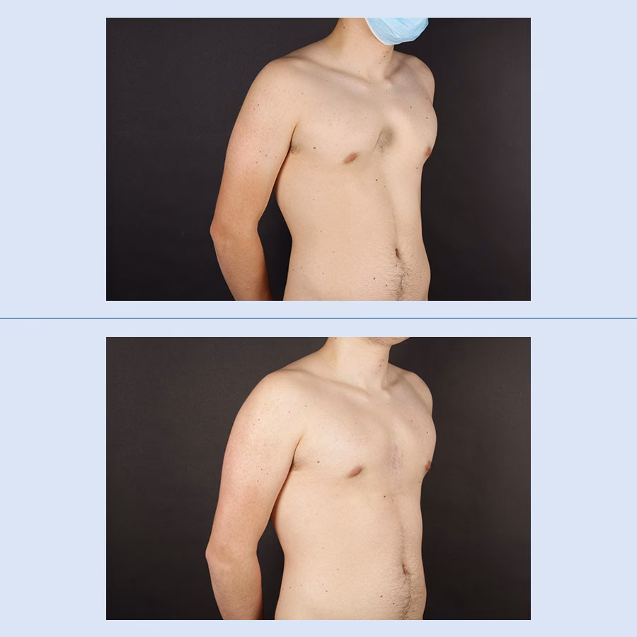 Cirugía Torácica: El Arte de Reparar el Pecho