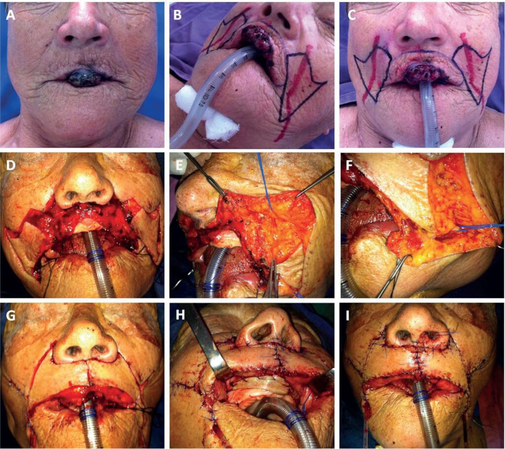 Todo Sobre la Cirugía de Colgajo Reconstructiva