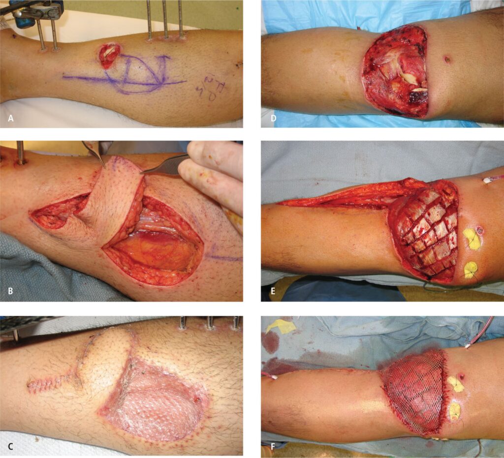Colgajo vs. Injerto: Diferencias Clave en Cirugía