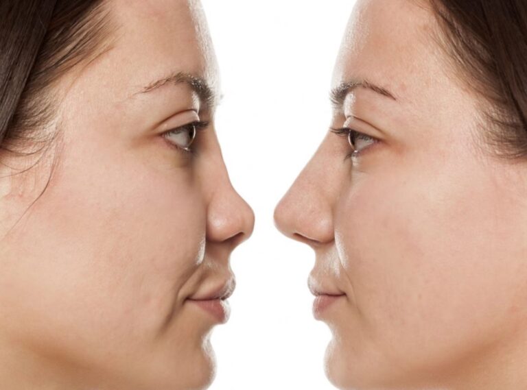 Riesgos y Consecuencias de la Rinoplastia