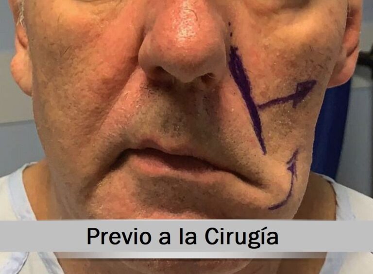 Cirug&iacute;a de Par&aacute;lisis Facial: Recupera tu Sonrisa