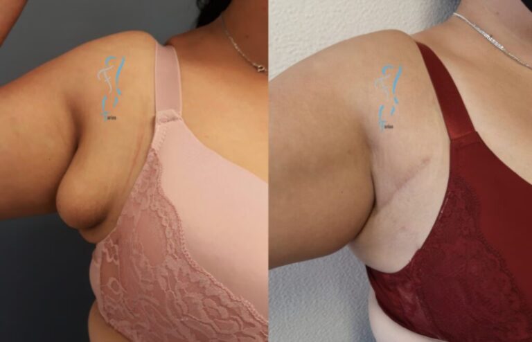 Mama Supernumeraria: Soluci&oacute;n al Tercer Seno Axilar