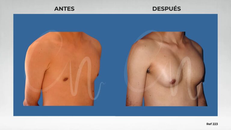 Aumento de Pecho Natural: &iquest;Cu&aacute;l es la Mejor Opci&oacute;n?
