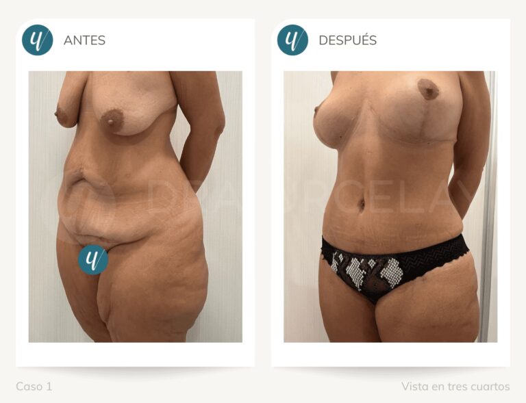 Reducci&oacute;n Mamaria: &iquest;Cu&aacute;l es la Talla Ideal?