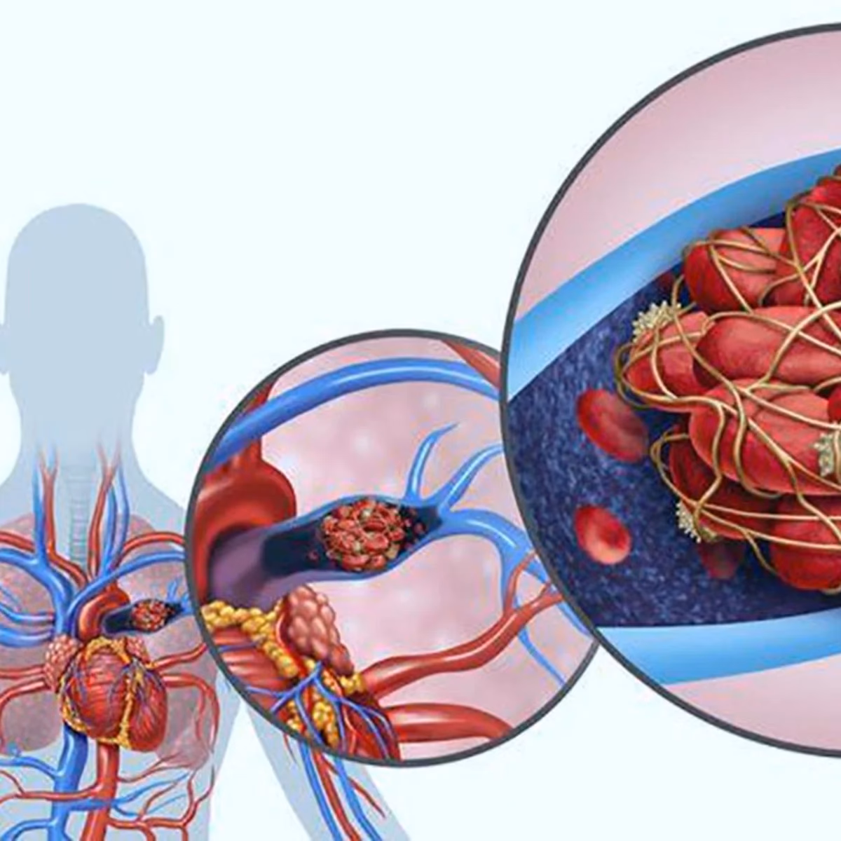 &iquest;C&oacute;mo evitar la embolia pulmonar en cirug&iacute;a pl&aacute;stica?