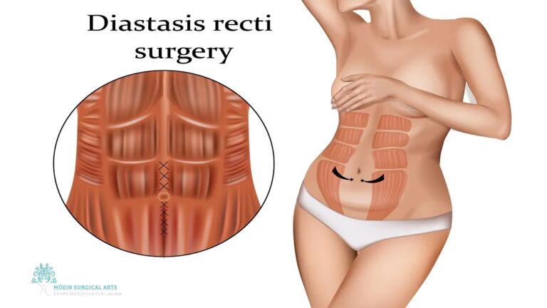 Di&aacute;stasis Abdominal y la Seguridad Social: Cobertura