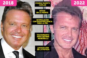 La Cirugía de Luis Miguel: ¿Manga Gástrica?