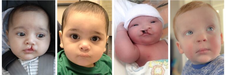 Palatoplastia: Cirug&iacute;a para el Paladar Hendido