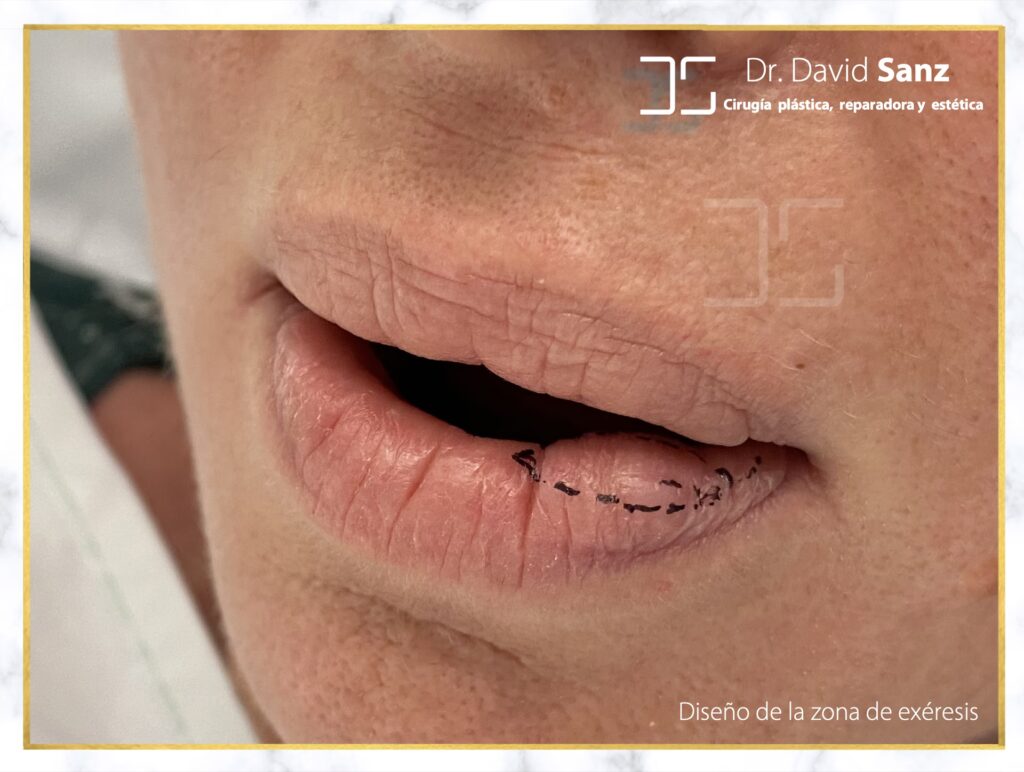 Biopolímeros: El Peligro Oculto en la Estética