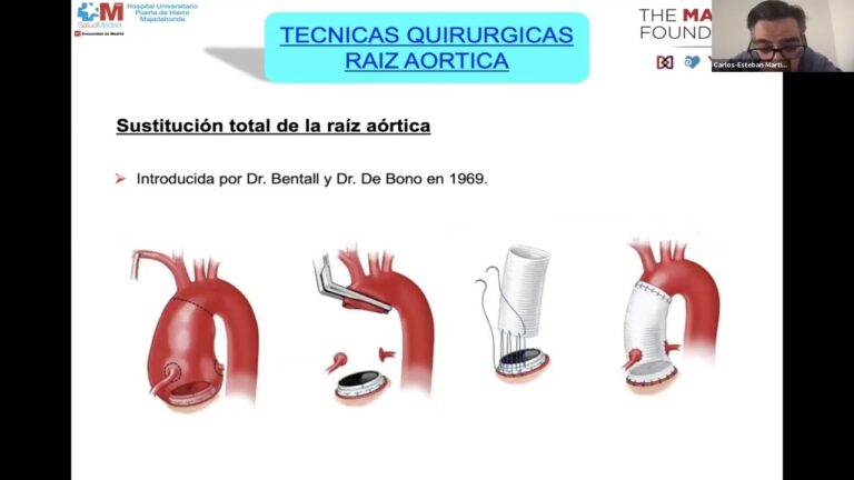 Cirug&iacute;a de Aneurisma de Aorta: T&eacute;cnicas y Pron&oacute;stico