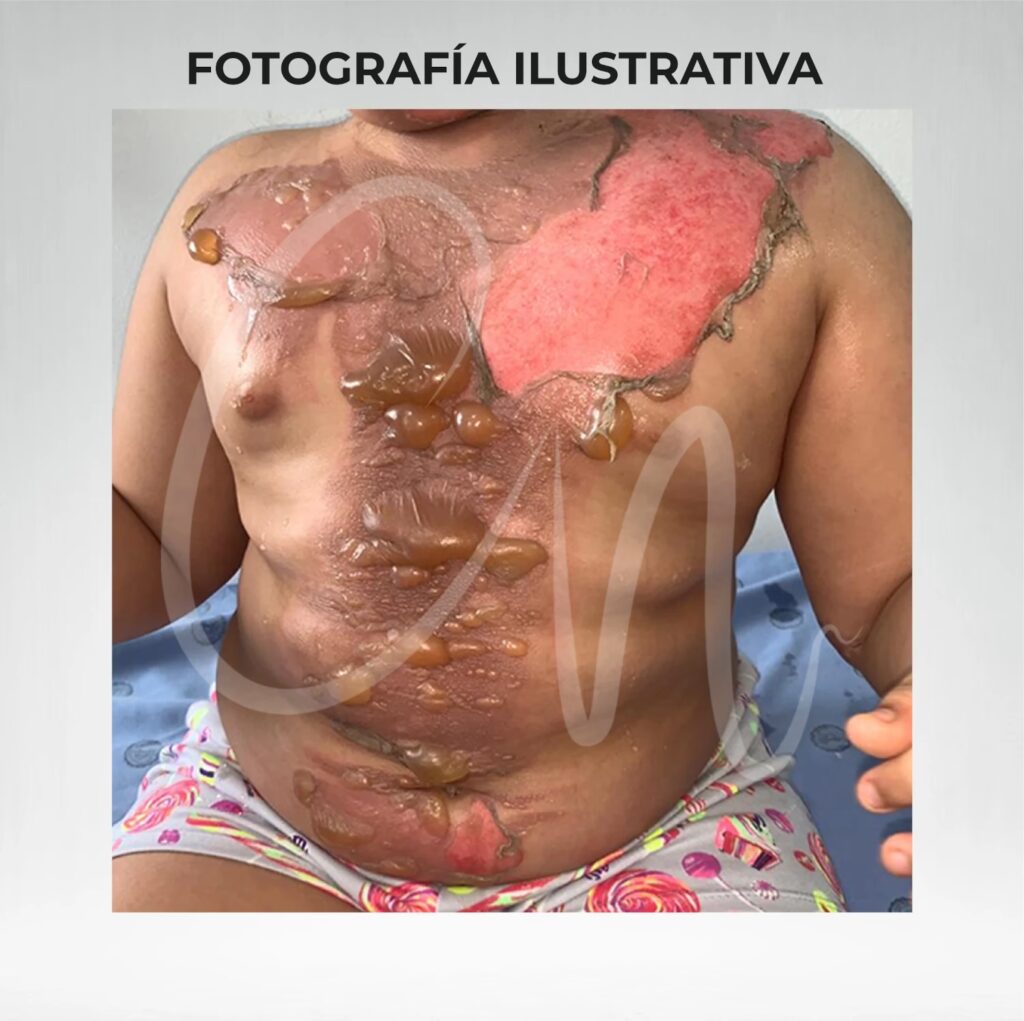 Cirugía por Quemaduras: ¿Cuándo es Necesaria?